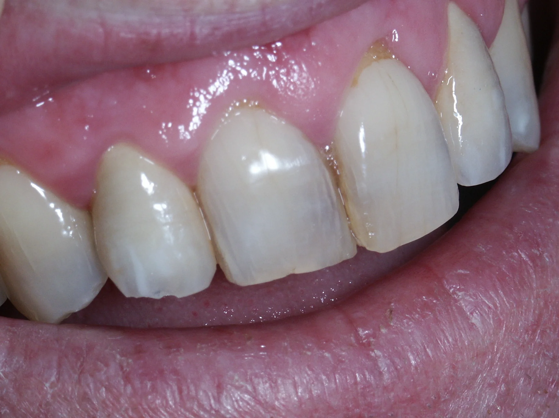 Aprés - Photo Philippe Clement