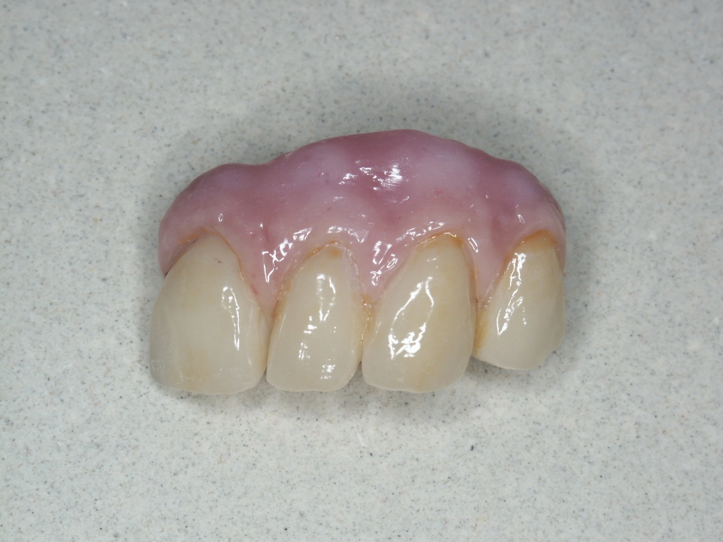 Bridge PRETTAU sur implants - Philippe CLEMENT