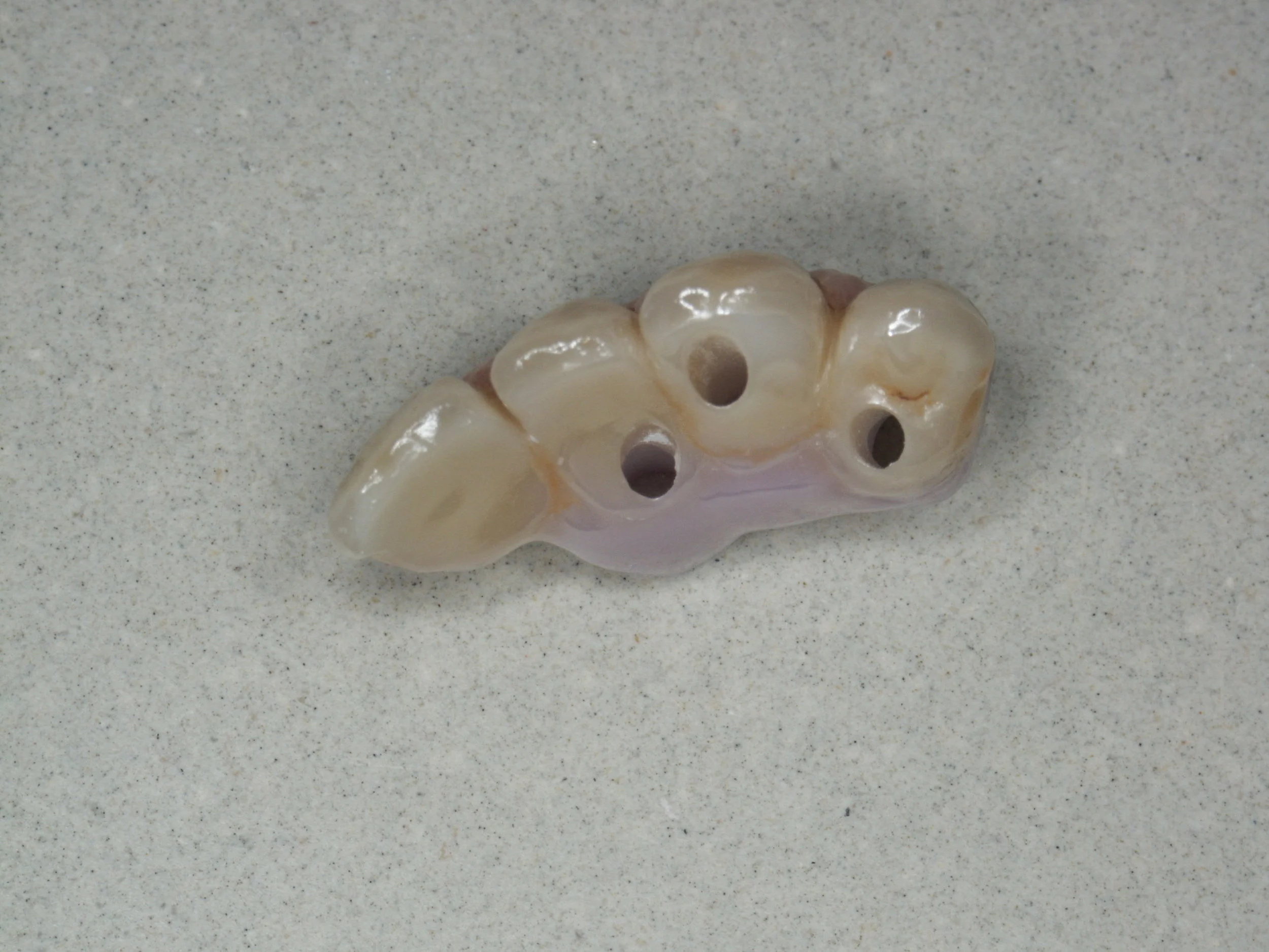 Bridge PRETTAU sur implants - Philippe CLEMENT