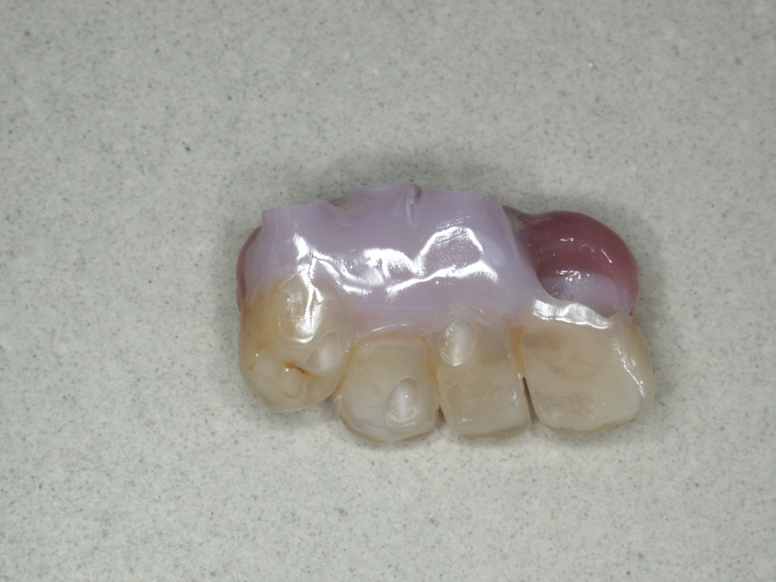 Bridge PRETTAU sur implants - Philippe CLEMENT