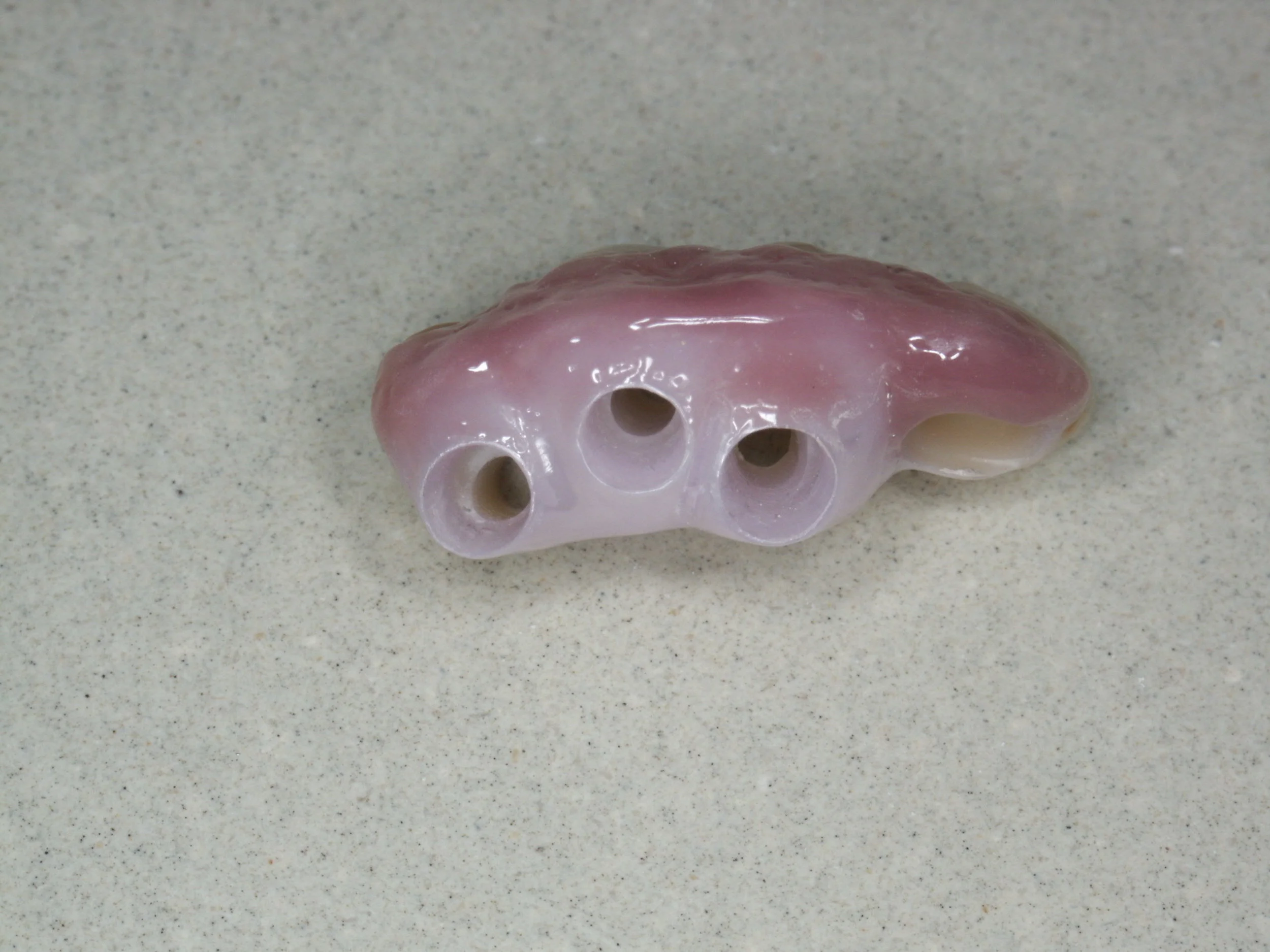 Bridge PRETTAU sur implants - Philippe CLEMENT