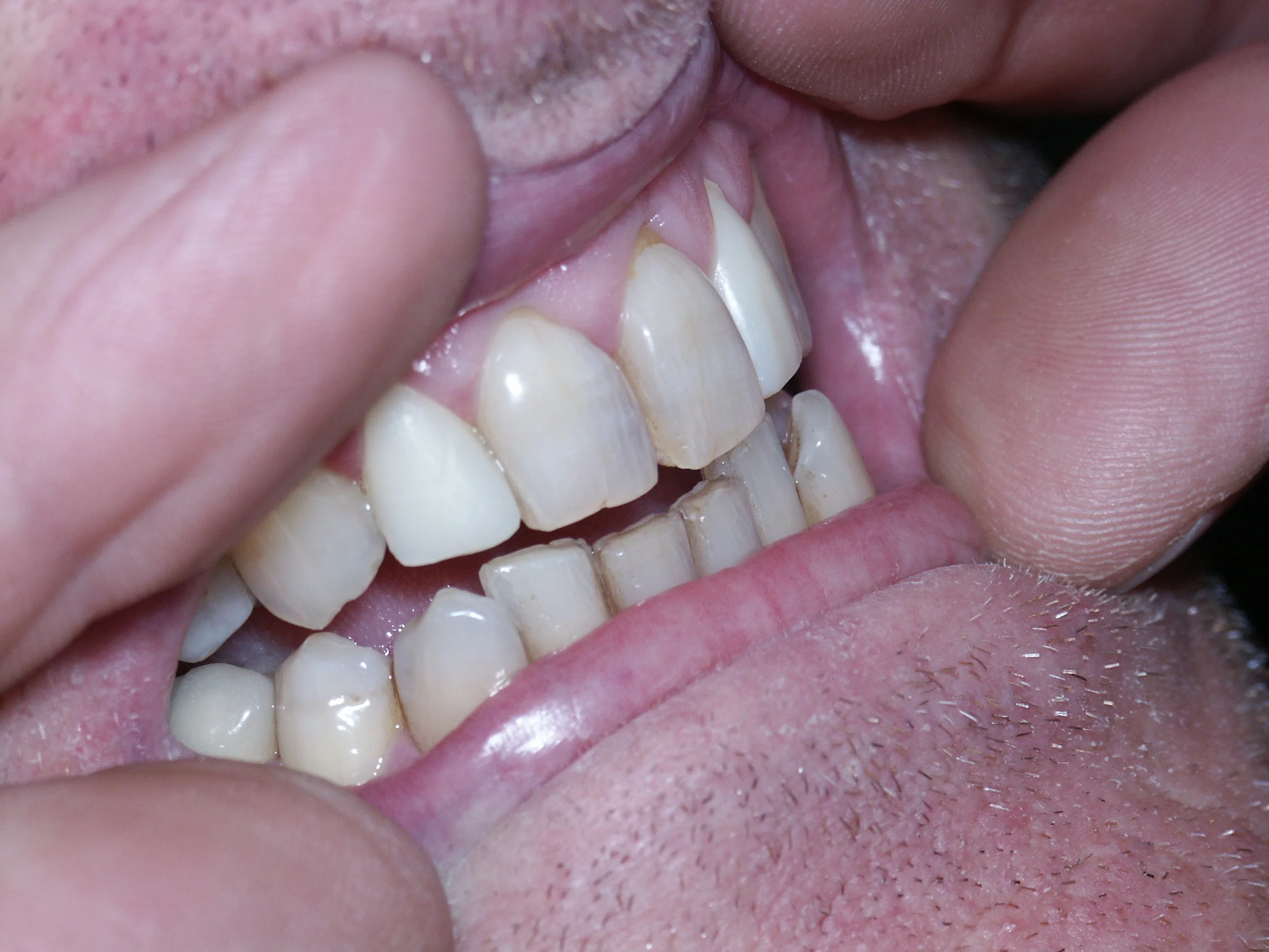 Avant - Dent provisoire