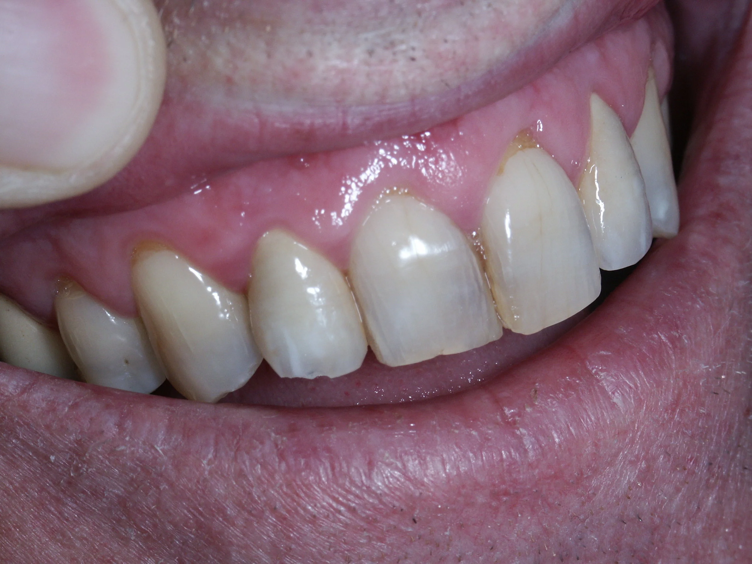 Aprés - Dent  céramo métallique