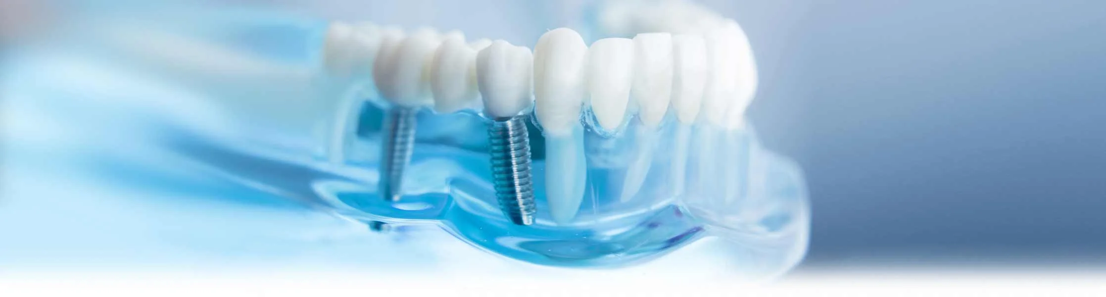 dental_implants.jpg