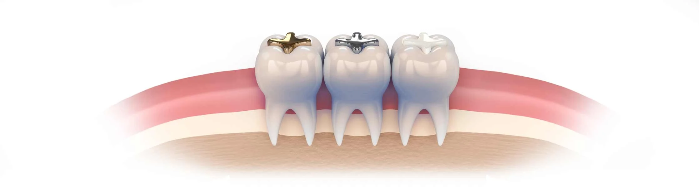 fillings.jpg