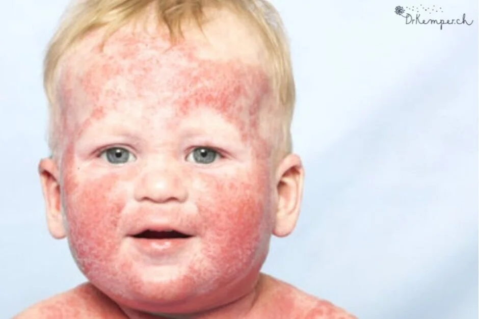 Neurodermitis bei Kindern Behandlung ohne Medikamente