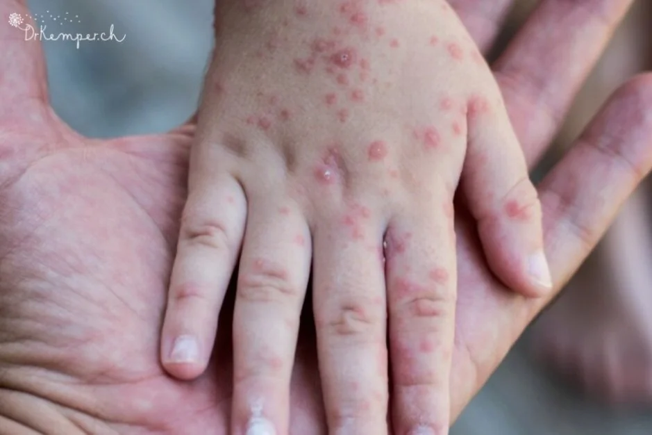 Hand Mund Fuß Nicht Mehr Ansteckend Die Hand-Mund-Fuss-Krankheit bei Kindern — Naturheilkunde für Kinder