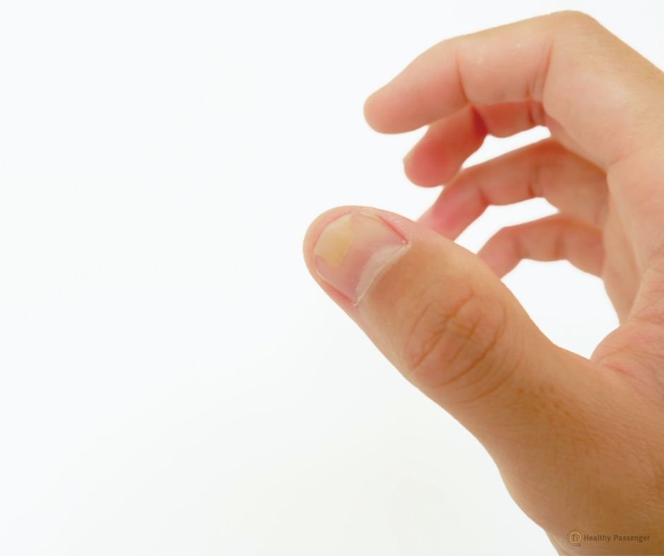 13 Ways To Get Rid Of Yellow Nails Naturally — Healthy Passenger