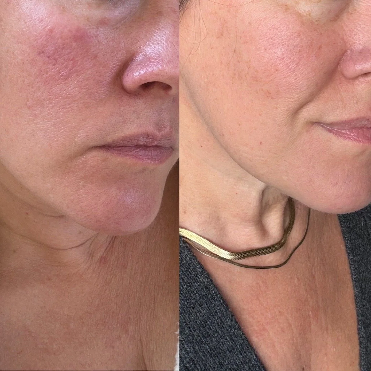 We Finally Tried This Cult Favorite Skincare Product And It Changed Our Skin. Before And After Photos Galore. 
