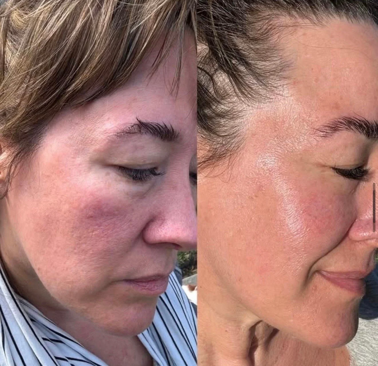 We fillinally tried this cult skincare product that people have raved about for 10 years. And? We're sorry to say it works.
Amazingly well. These photos were taken 2 weeks apart.

Link in bio.

#LetsTalkCandidly
🔗: https://www.thecandidly.com/articl