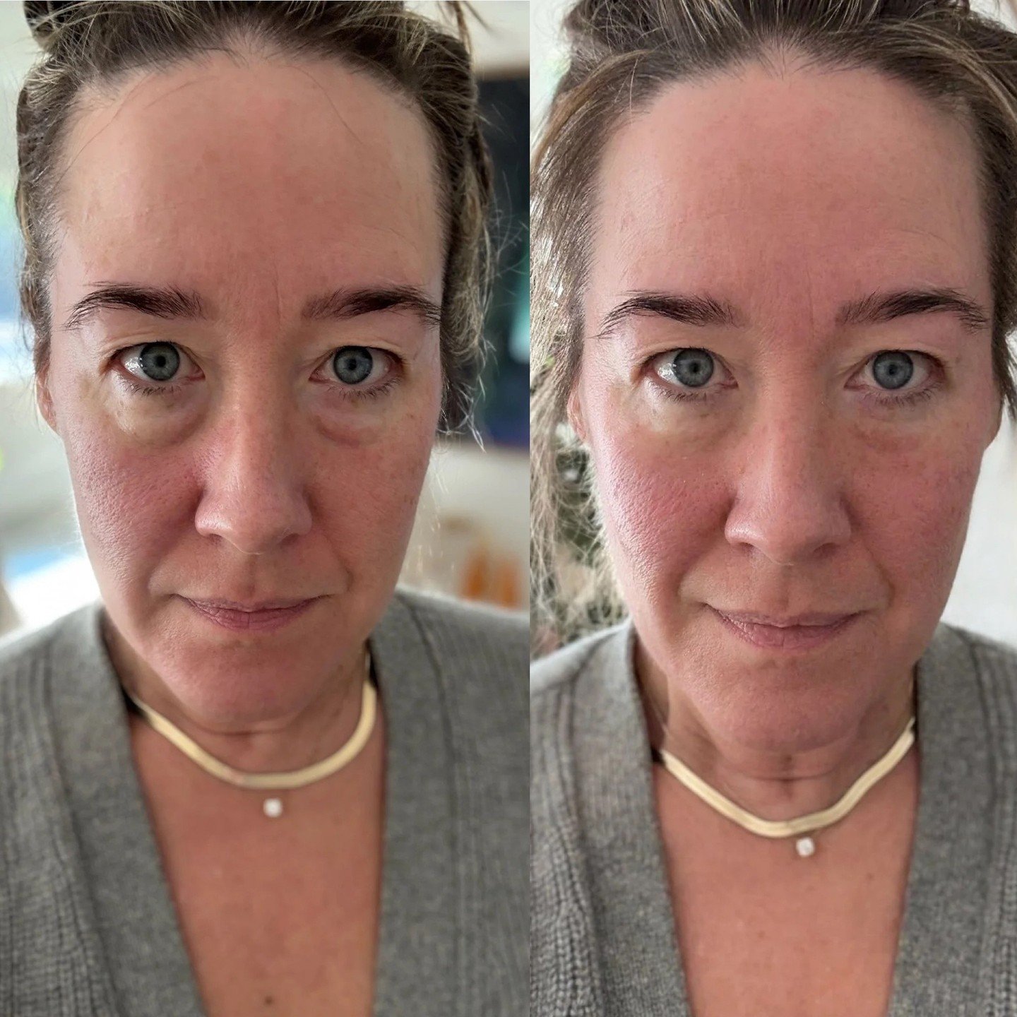 We found a semi-miracle product that got rid of 90% of our eye bags. It&rsquo;s under $40, it works under makeup, and we&rsquo;re very impressed. It&rsquo;s not perfect, but you&rsquo;ll see why in the article. 

Link in bio. 

#LetsTalkCandidly
🔗: 