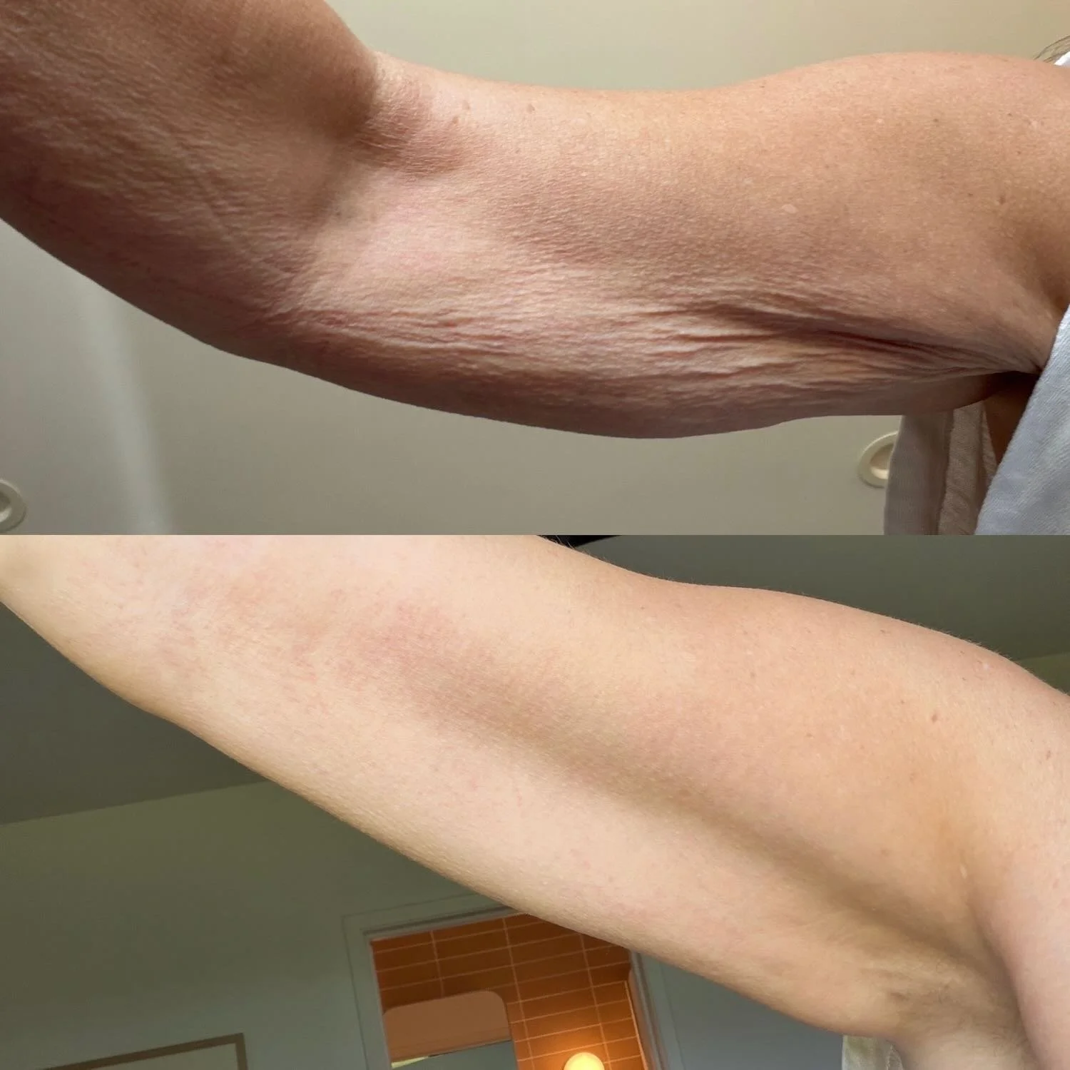 This Product ... Actually Got Rid Of Our Arm Crepe. And We Sort Of Don’t Believe Our Eyes. 