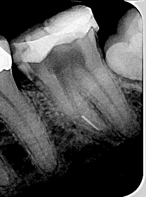 Body Modifications Gone Wrong