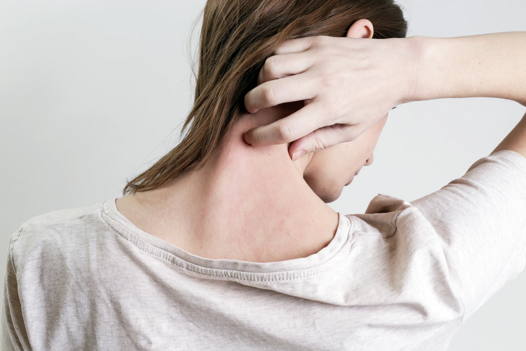 Best Way to Heal Eczema Naturally