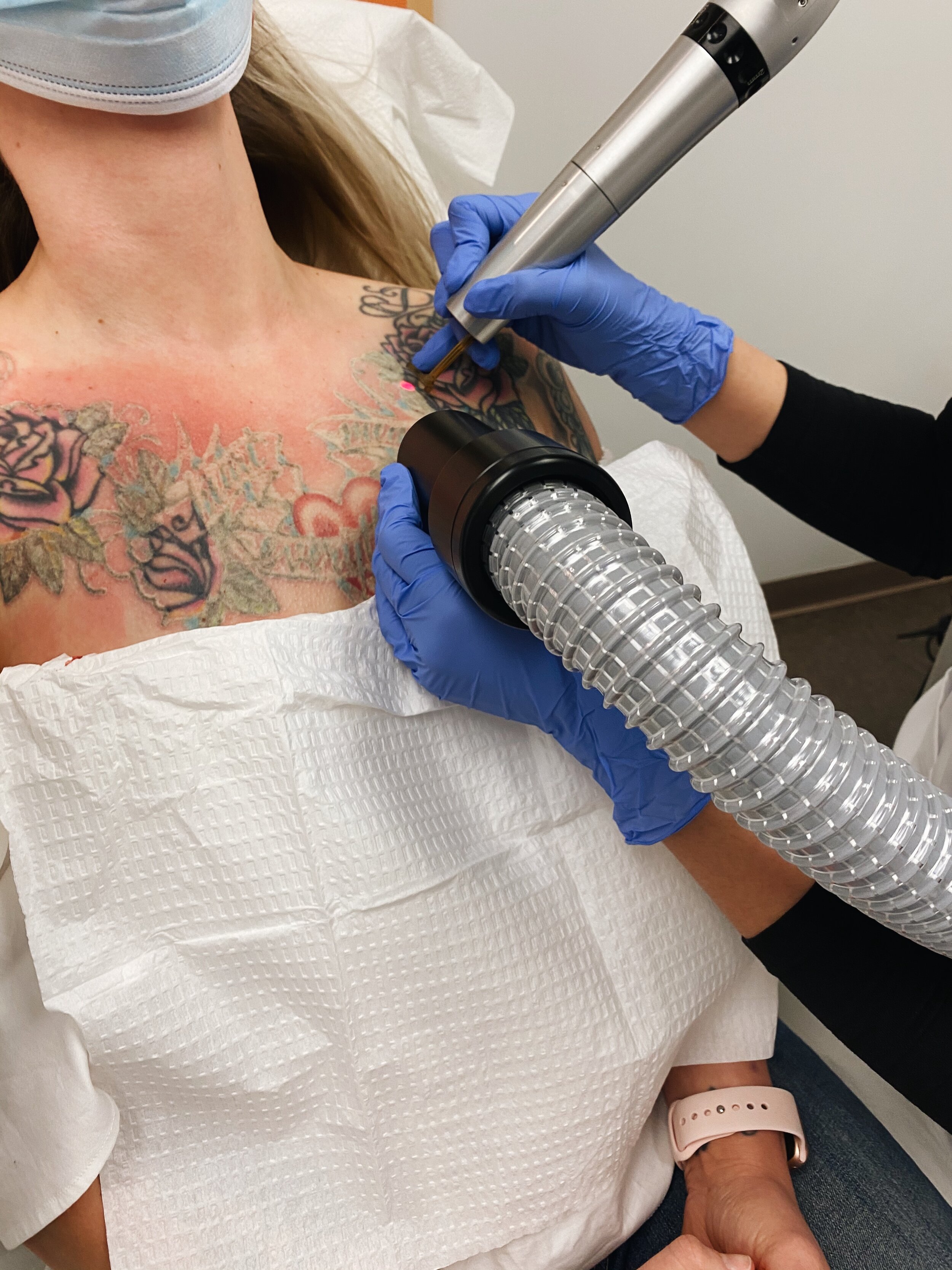 My 1st Two Tattoo Removal Sessions — Dani Hampton