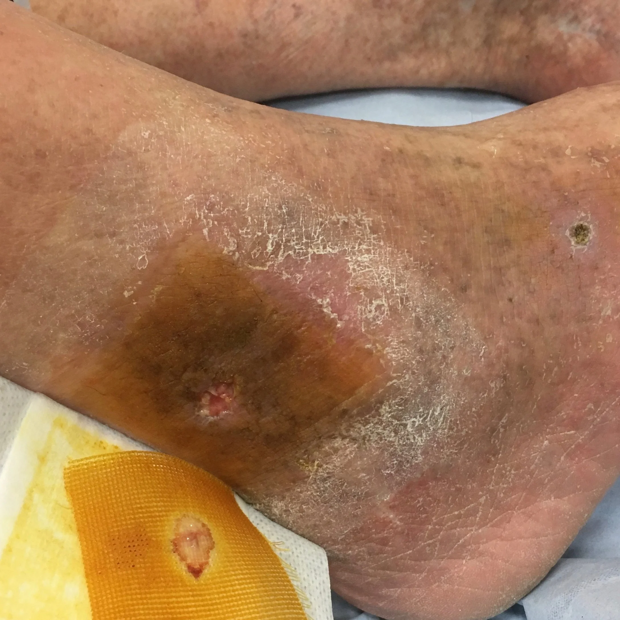 arterial+ulcer.jpg