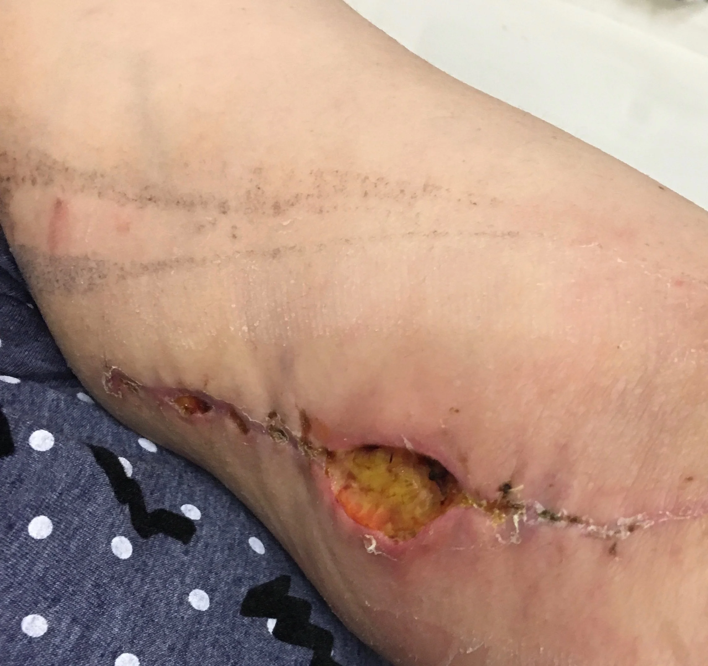 wound+infection.jpg