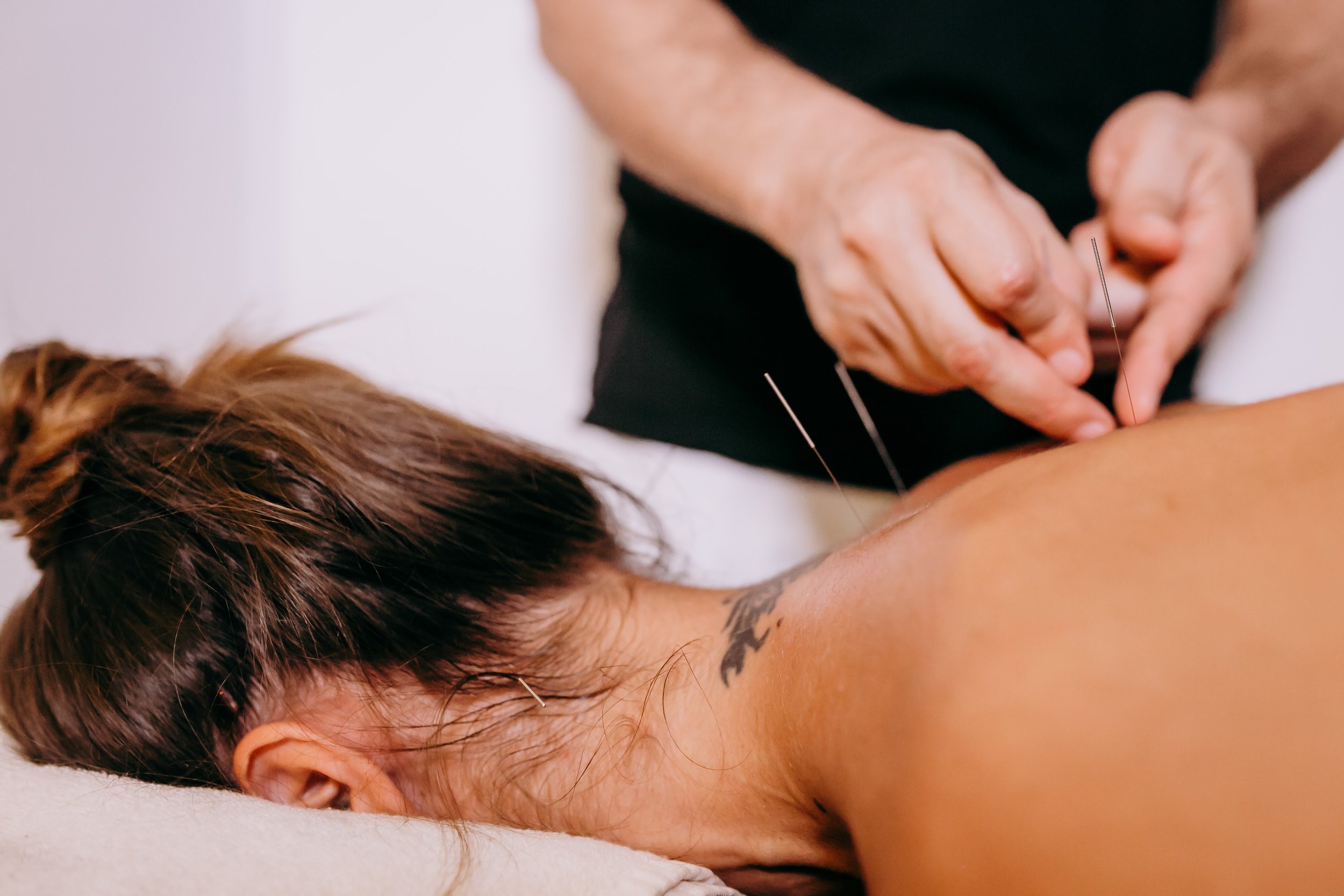A woman facedown being treated with acupuncture. (Copy)