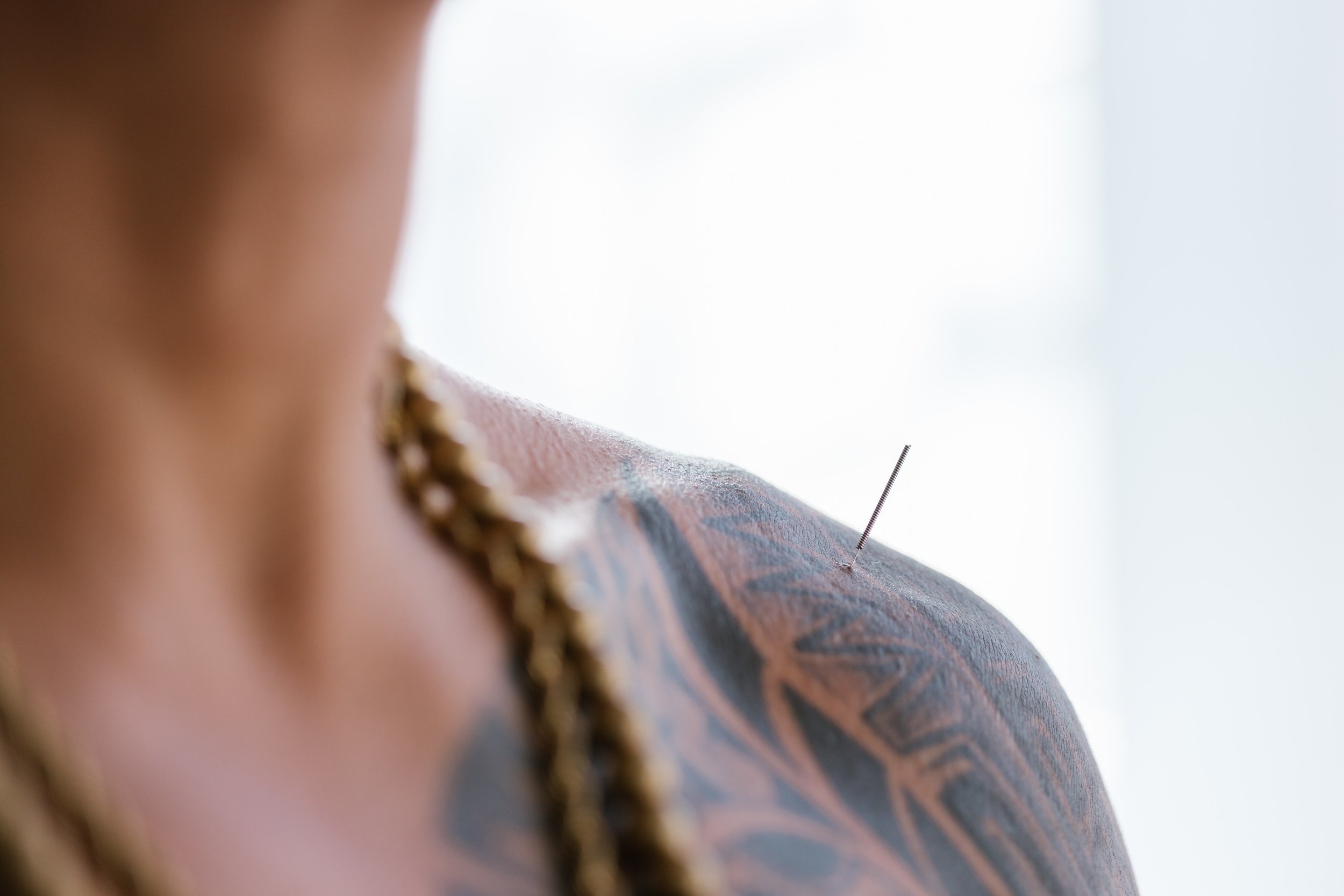 A man with acupuncture needles along his left shoulder. (Copy)