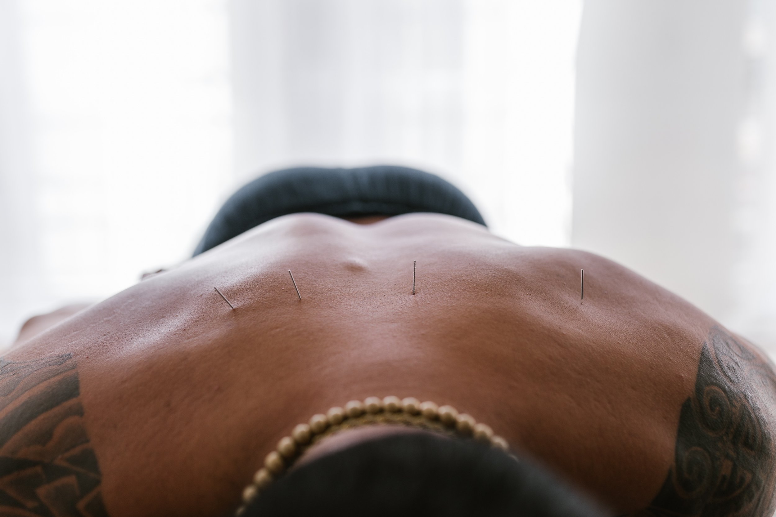 A close up of a man facedown with acupuncture needles in his back. (Copy)