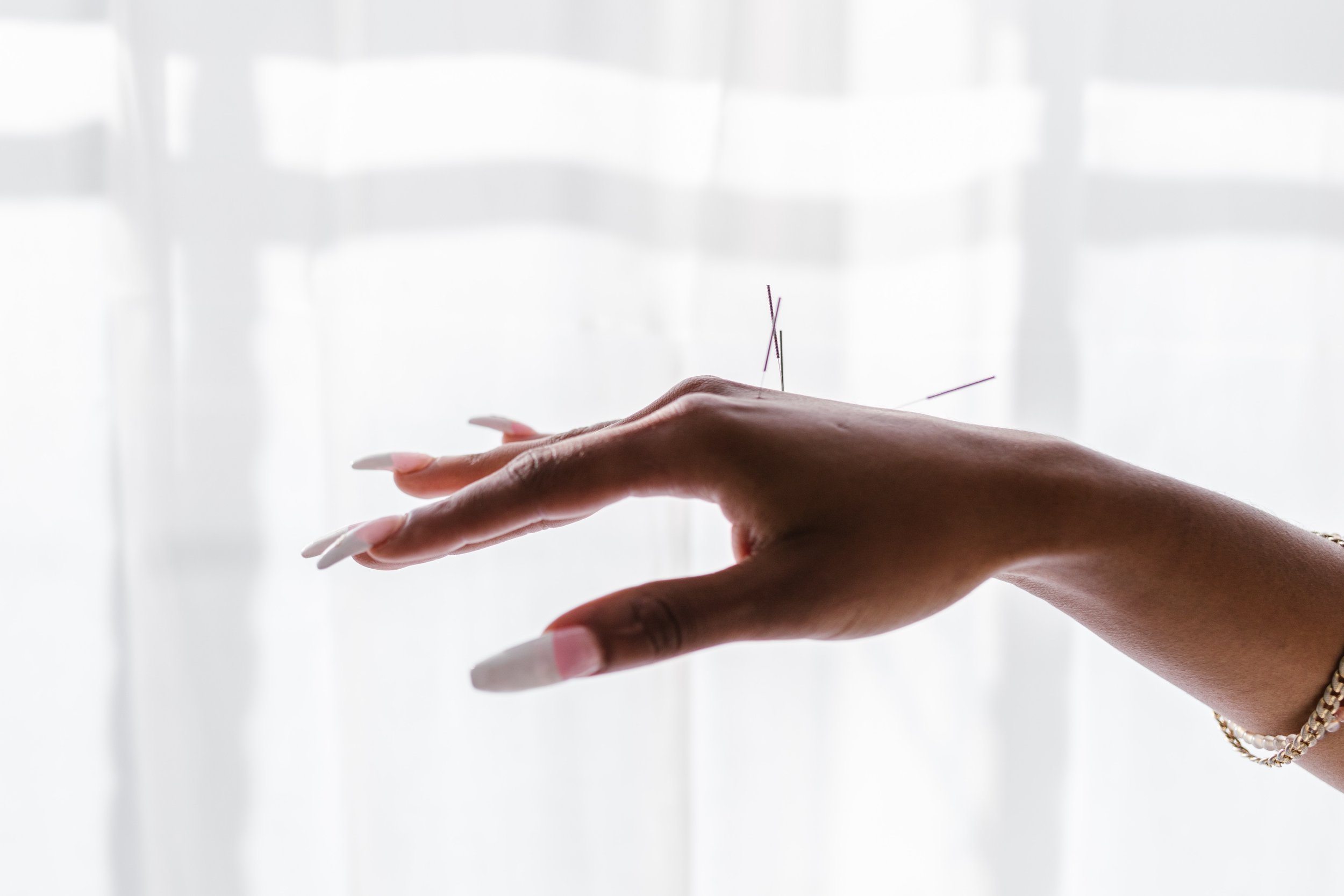 A close up of a woman's hand with acupuncture needles in it. (Copy)
