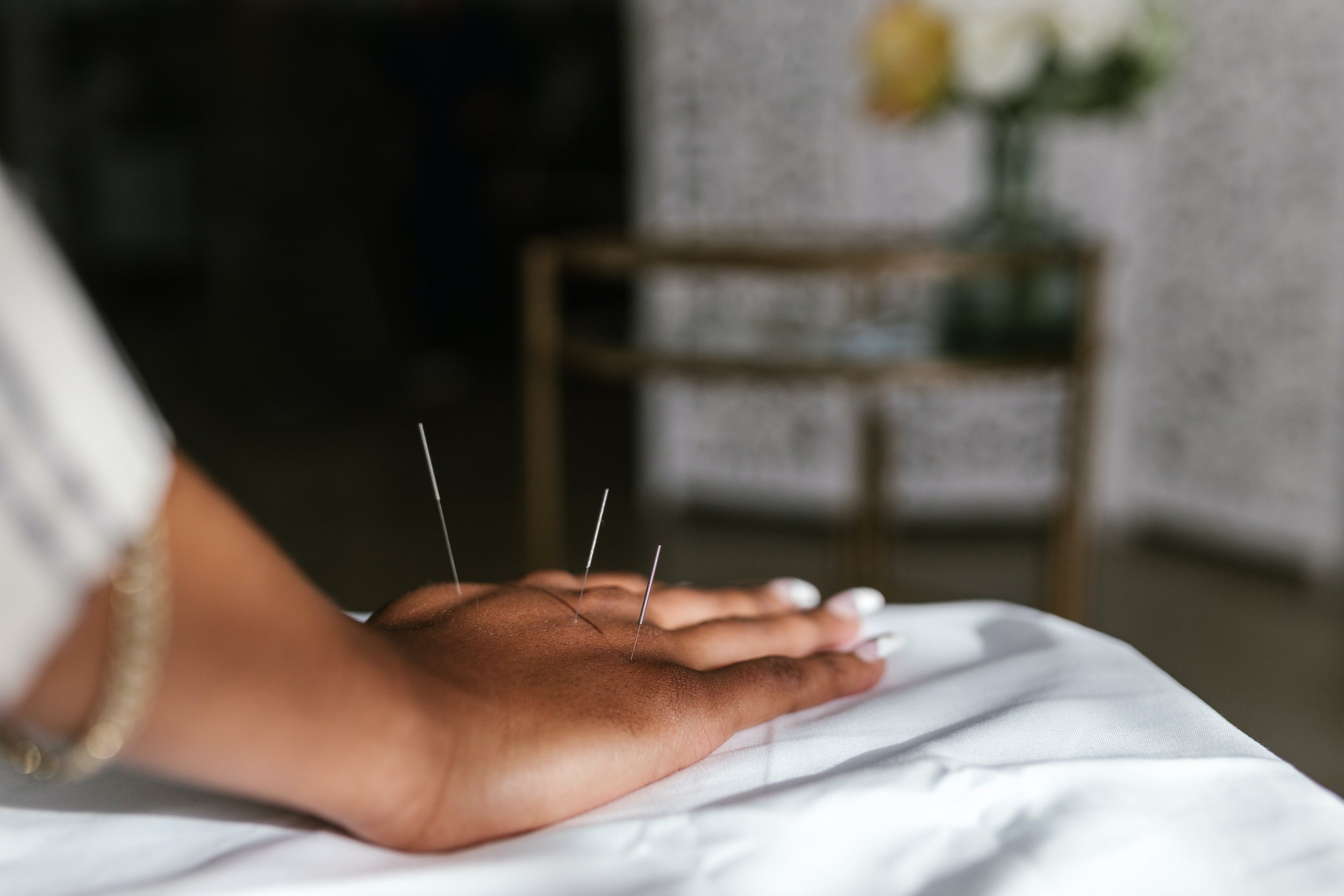 A woman's hand with acupuncture needles. (Copy)