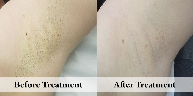 Hair-Removal-2.jpg