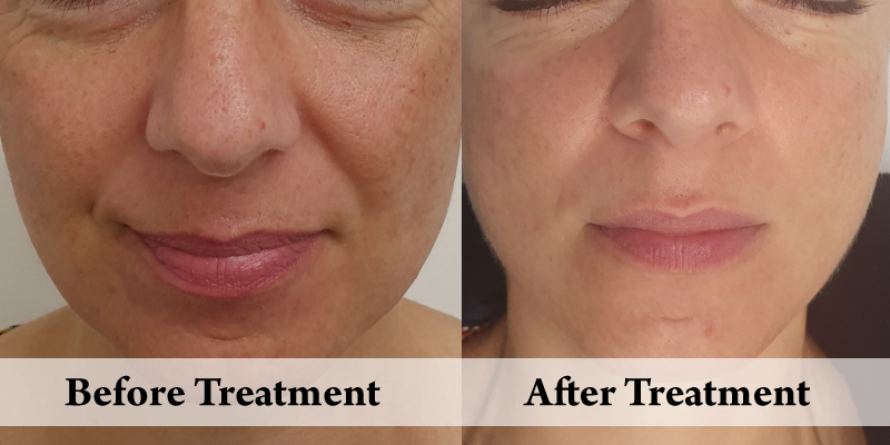 Peels-Pigmentation & Skin Rejuvenation - front.png