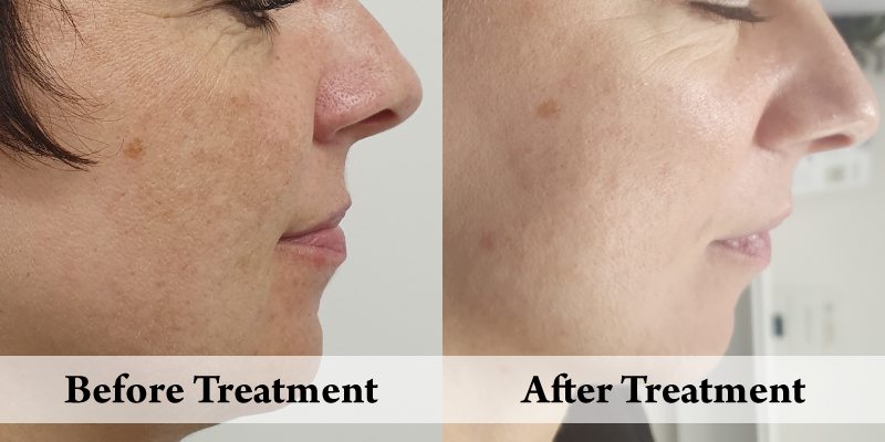 Peels- Pigmentation & Skin Rejuvenation -Right.png