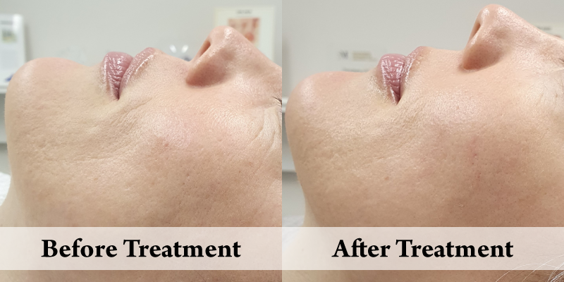 eTwo- Skin Rejuvenation & Anti-Wrinkle - Right.png