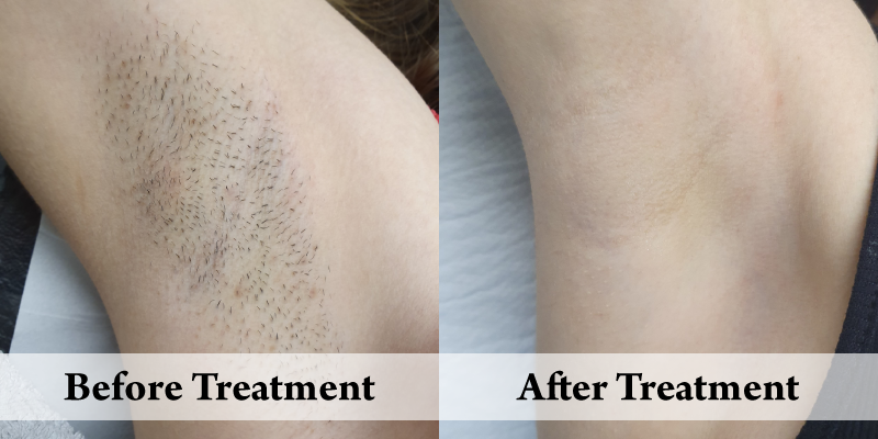 Before-And-After-Website Hair Removal Underarm Right.png