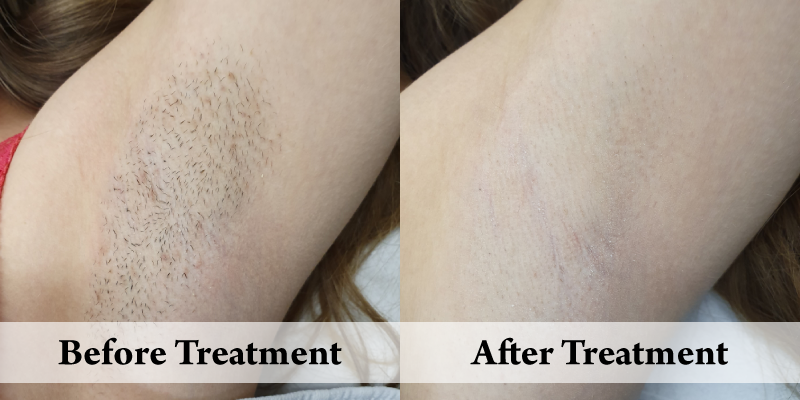 Before-And-After-Website Hair Removal Underarm Left.png