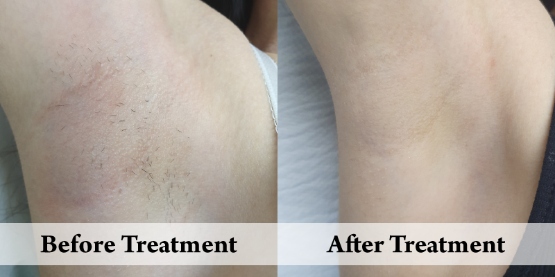 Before-And-After-Website-Hair Removal Underarm.png