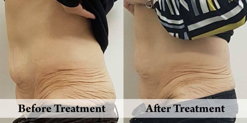 Before-And-After-Website SKin Tightening Stomach.png