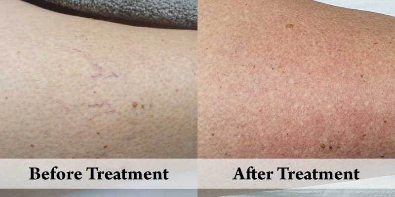 Thread Vein Removal Right Thigh top.png