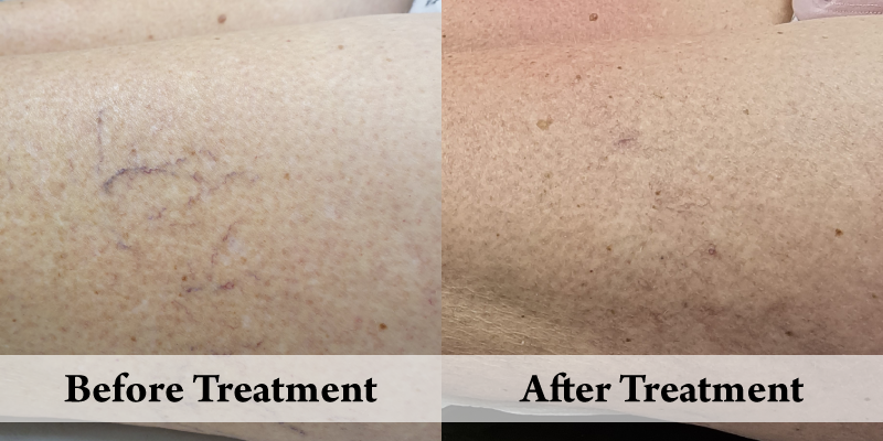 Thread veins Removal top thigh.png