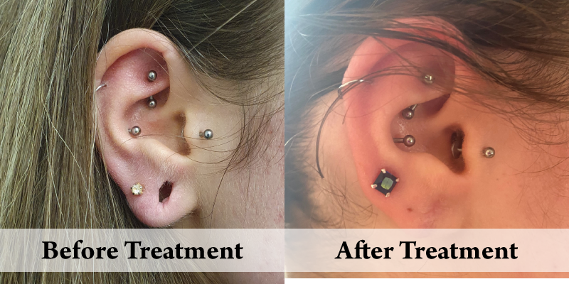 Stretched earlobe right before and after.png