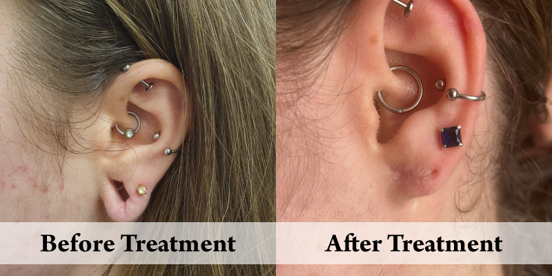 Stretched earlobe left before and after.png