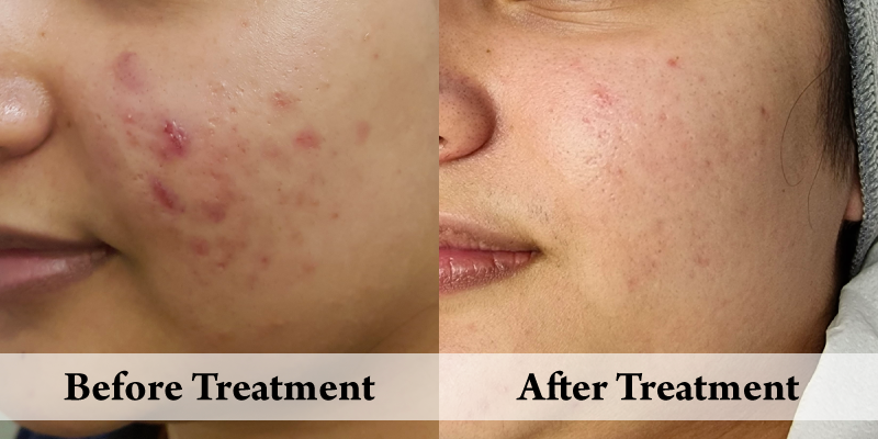 Before-And-After-Acne Left Cheek.png