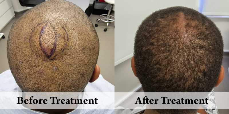 Before-And-After-Lipoma 1.png