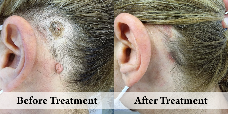 Before-And-After-Scalp Lesion.png