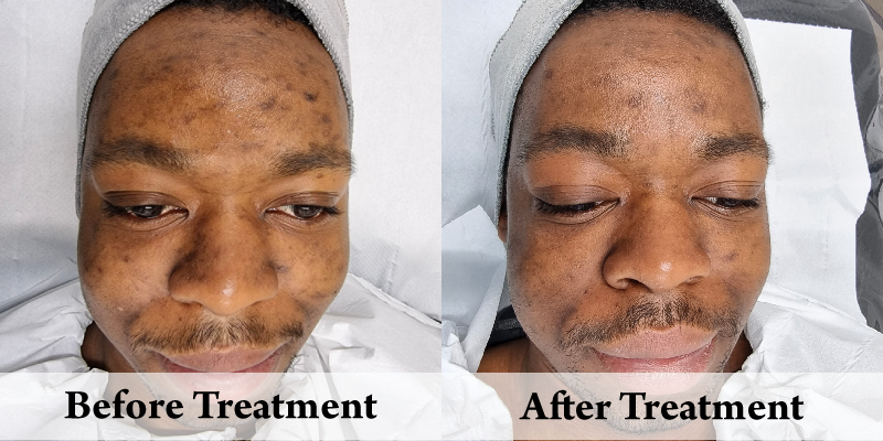 Acne Treatment Front Right.png