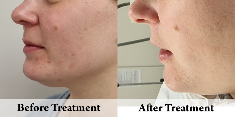 Acne Treatment left chin.png