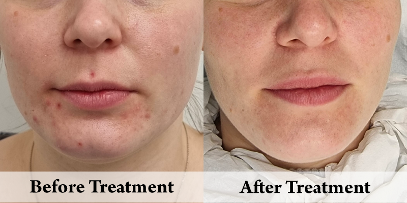 Acne Treatment chin front.png