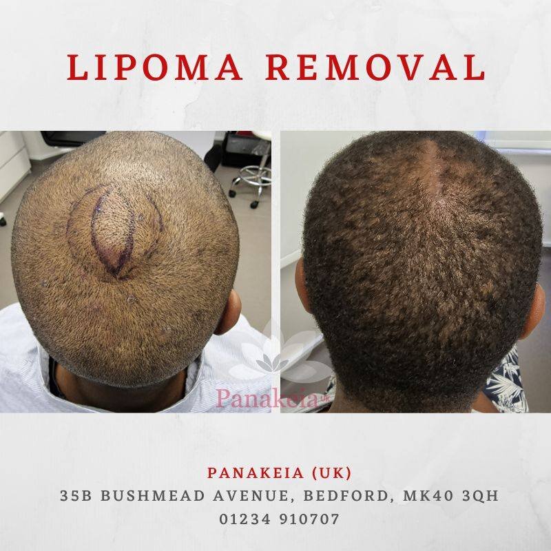 There isn't anything too difficult or too awkward for our surgeons to remove or operate on!
In under an hour, this lipoma was carefully removed from the scalp all under local anaesthetic. 
If you have a lump, bump or lesion you want removing, book yo