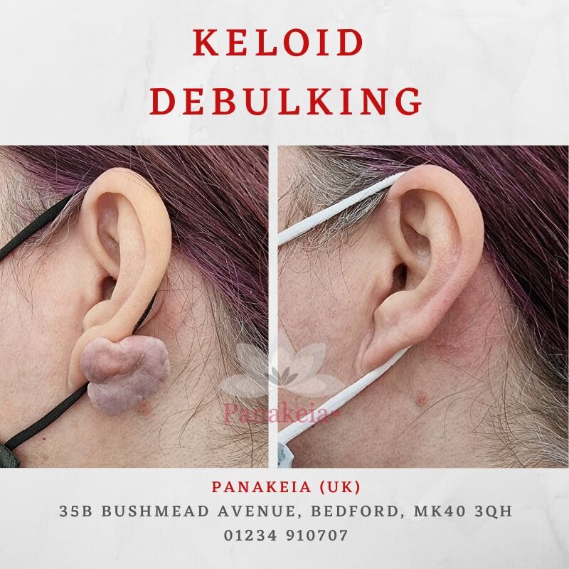 Our team have worked their magic again transforming this patients ear. 
With a growing keloid in a prominent location, it made this patient very self conscious and unhappy with the way she looked. Our surgeon skill-fully debulked the keloid without a