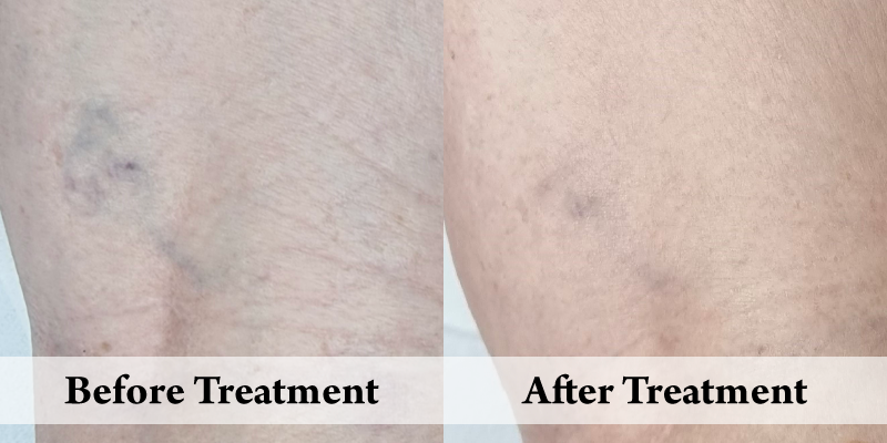 Thread Vein Removal.png