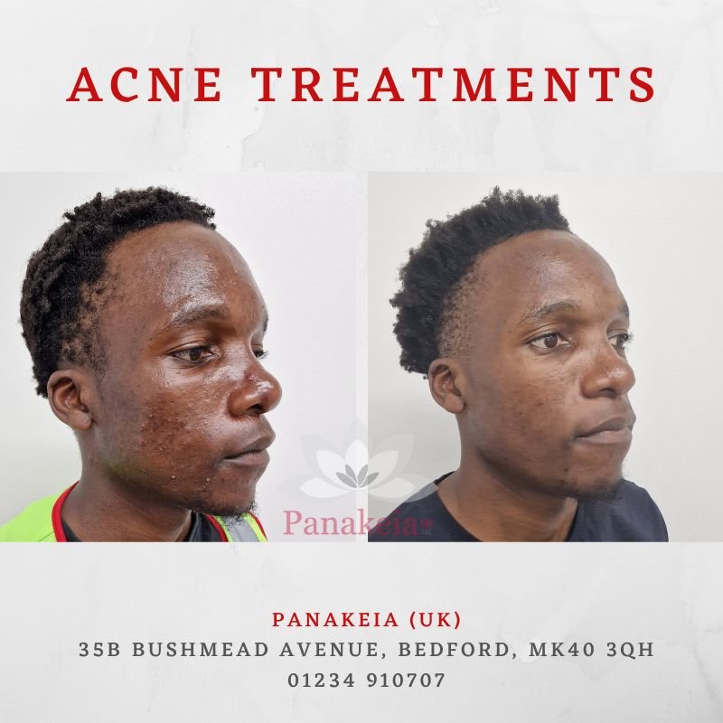 Another transformation, and another happy patient. 🙌

Nothing gives us greater pleasure than restoring someone's confidence....

We love helping people and can treat all skin types so if you are suffering from troublesome acne or have poor skin heal