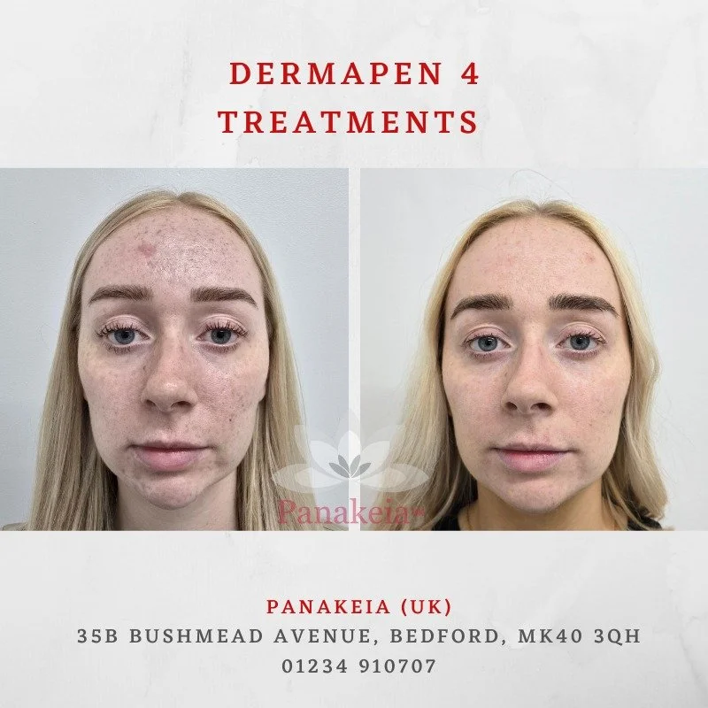 Wow 😍 wow 😍wow 😍 is all we can say when we look at this incredible transformation with a SINGLE treatment of Dermapen 4! 

Not only has the acne scarring reduced but this lovely patients acne and pores have too all in one go. 🙌

If this is the gl