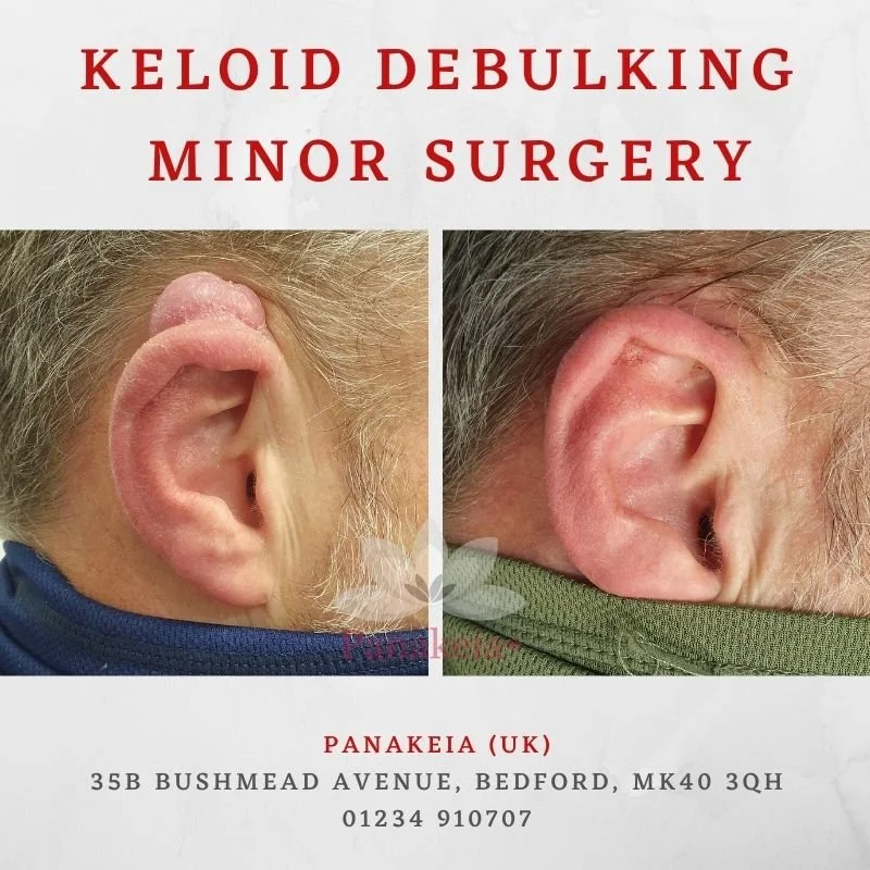 Keloids can appear anywhere on the body but often are found on the ear. They tend to be unsightly and painful requiring treatment. 

Keloid debulking treatments with steroid injections are an excellent way to control the unwanted growths. 
Skill is n